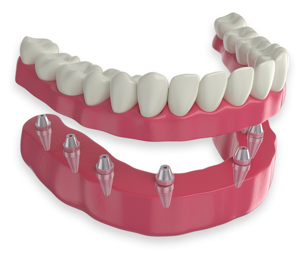 Ilustração de implante e prótese dentária